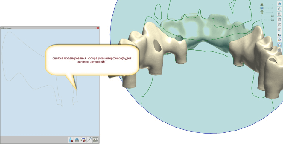16 рекомендаций по CAD CAM моделированию ортопедических конструкций 7 - Фрезерный CAD/CAM центр Ортос Новости