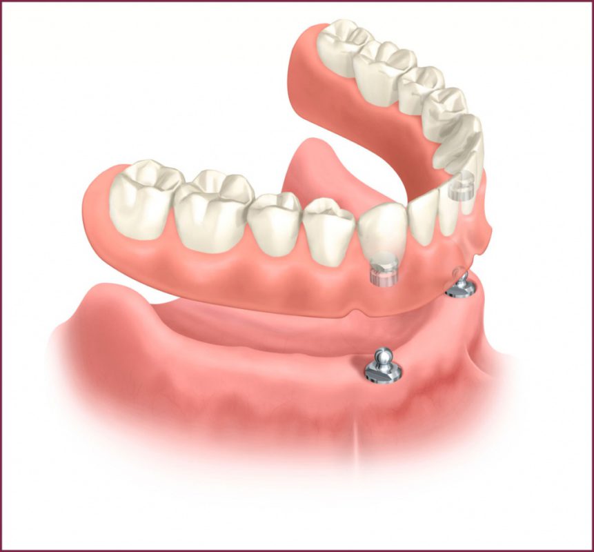 Акриловые зубные протезы 3 - Фрезерный CAD/CAM центр Ортос Полезные статьи