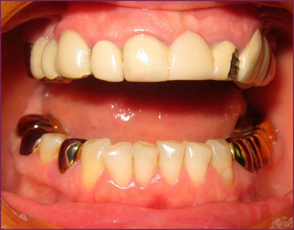 Фасетки и изготовление зубных протезов 5 - Фрезерный CAD/CAM центр Ортос Полезные статьи
