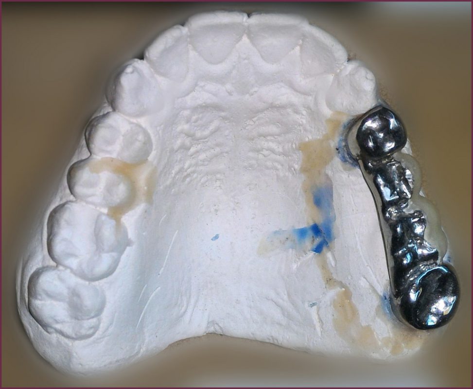 Гальваника и электрохимия в стоматологии 9 - Фрезерный CAD/CAM центр Ортос Полезные статьи