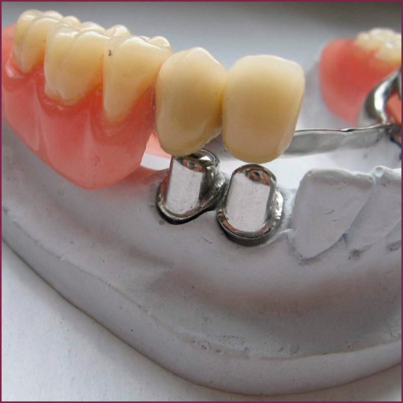 Гальваника и электрохимия в стоматологии 5 - Фрезерный CAD/CAM центр Ортос Полезные статьи
