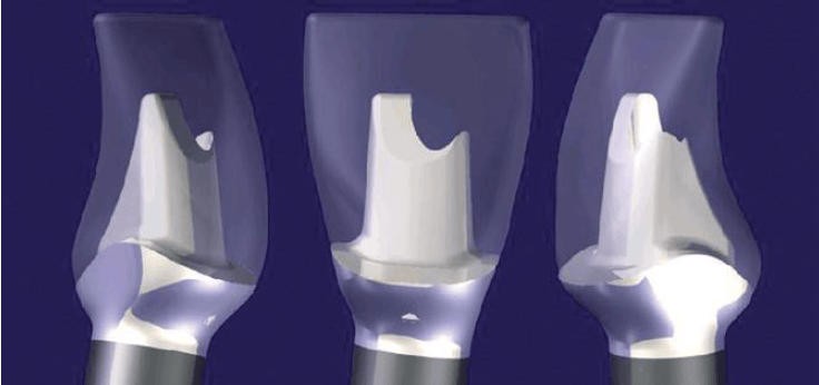 История развития CAD/CAM технологий в ортопедической стоматологии 5 - Фрезерный CAD/CAM центр Ортос Новости