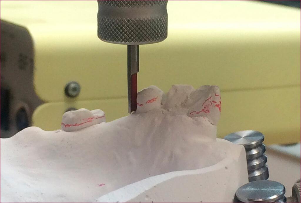Изготовление бюгельных протезов на основе параллелометрии 4 - Фрезерный CAD/CAM центр Ортос Новости