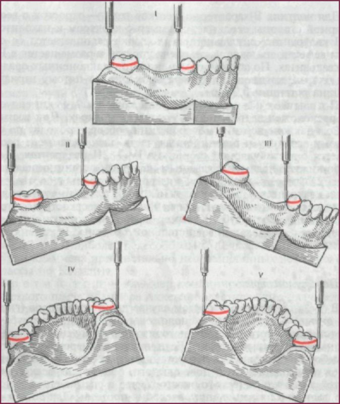 Изготовление бюгельных протезов на основе параллелометрии 5 - Фрезерный CAD/CAM центр Ортос Новости