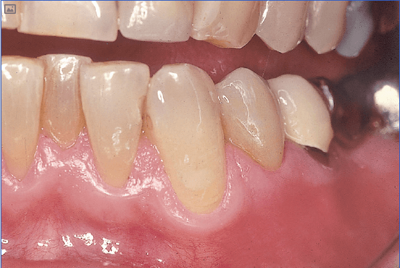 Химический состав стоматологической керамики - подробное описание 1 - Фрезерный CAD/CAM центр Ортос Полезные статьи