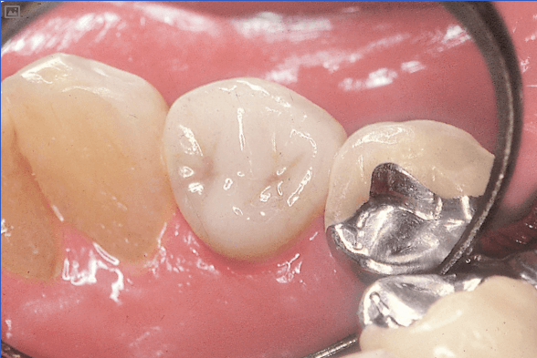 Химический состав стоматологической керамики - подробное описание 2 - Фрезерный CAD/CAM центр Ортос Полезные статьи