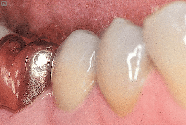 Химический состав стоматологической керамики - подробное описание 3 - Фрезерный CAD/CAM центр Ортос Полезные статьи