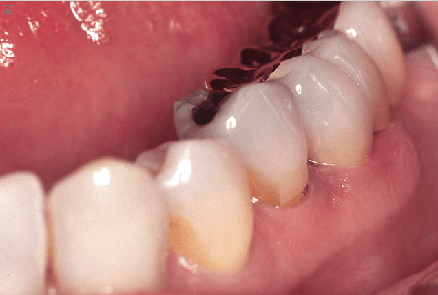 Химический состав стоматологической керамики - подробное описание 4 - Фрезерный CAD/CAM центр Ортос Полезные статьи