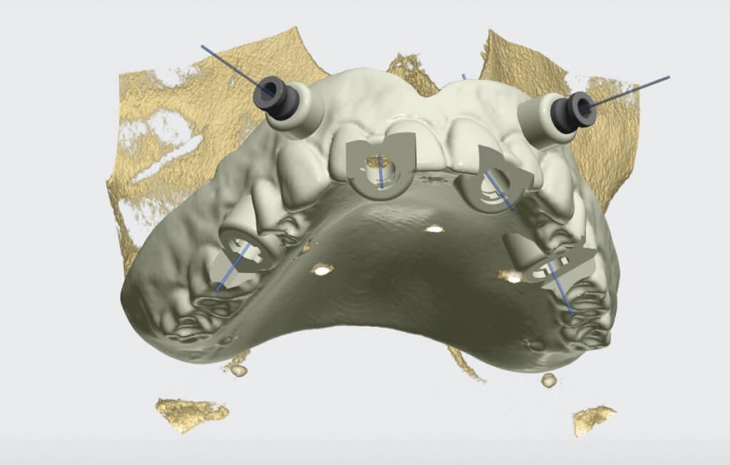 Хирургические шаблоны — применение в дентальной имплантации 9 - Фрезерный CAD/CAM центр Ортос Новости