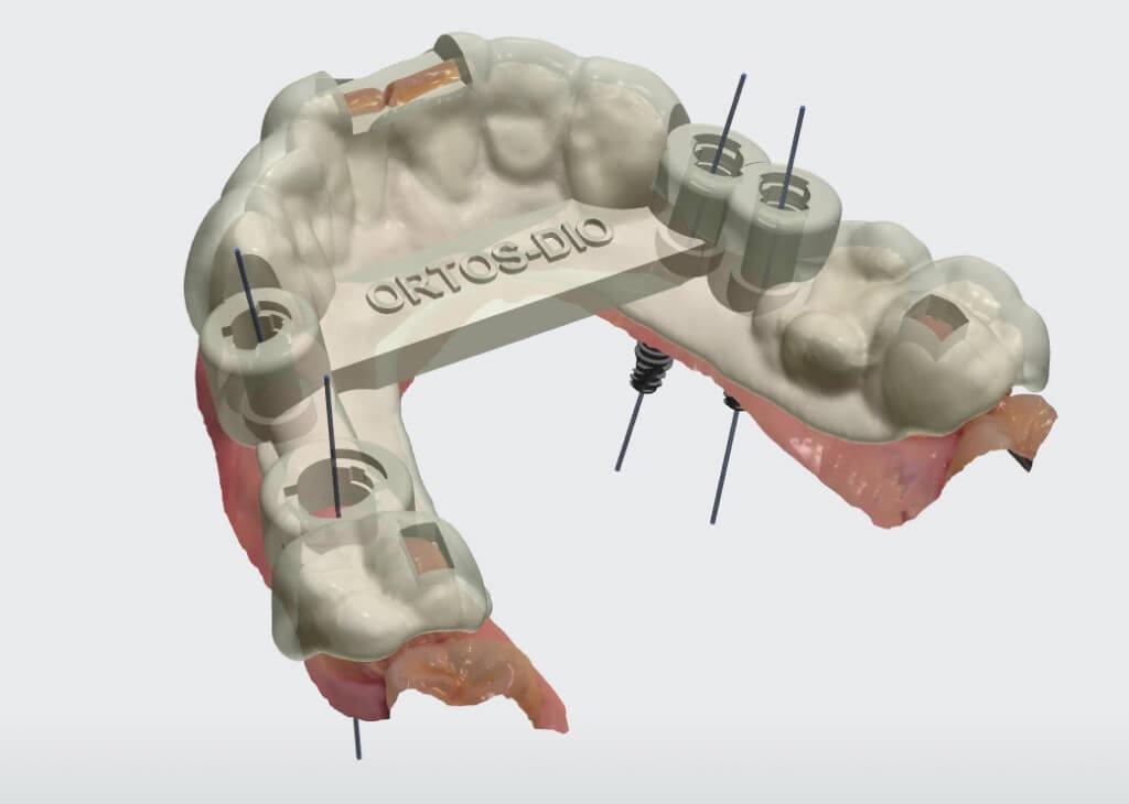 Хирургические шаблоны — применение в дентальной имплантации 11 - Фрезерный CAD/CAM центр Ортос Новости
