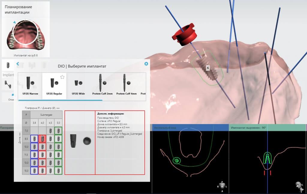 Хирургические шаблоны — применение в дентальной имплантации 5 - Фрезерный CAD/CAM центр Ортос Новости