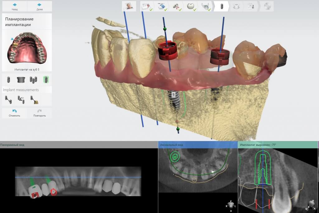 Хирургические шаблоны — применение в дентальной имплантации 6 - Фрезерный CAD/CAM центр Ортос Новости