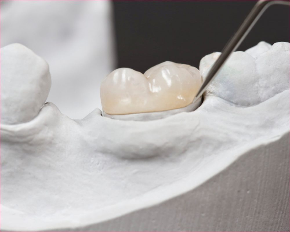 Классификация материалов в ортопедической стоматологии: стеклоиономерный цемент 5 - Фрезерный CAD/CAM центр Ортос Полезные статьи