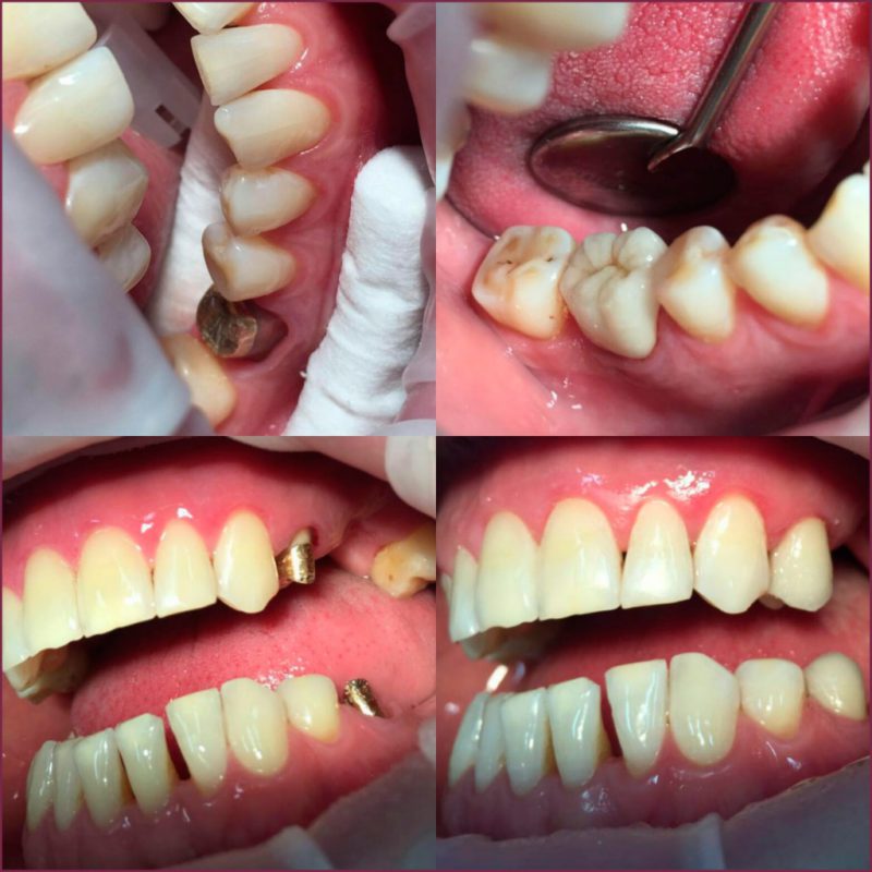Классификация материалов в ортопедической стоматологии: стеклоиономерный цемент 7 - Фрезерный CAD/CAM центр Ортос Полезные статьи