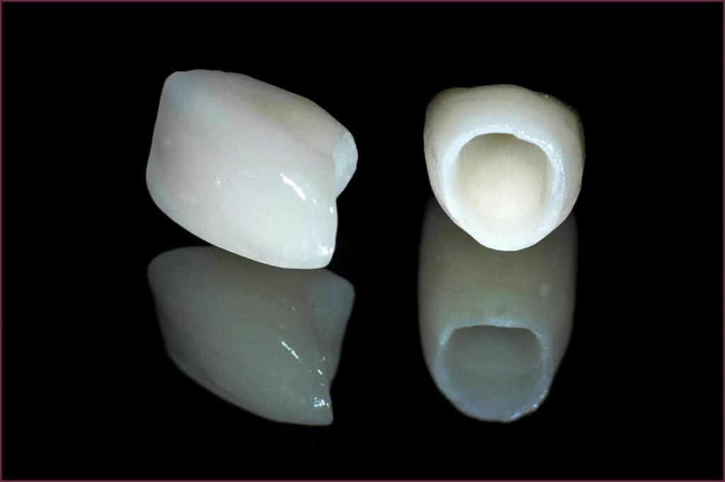 Металлоакрил и зубные протезы - принципы создания 9 - Фрезерный CAD/CAM центр Ортос Новости
