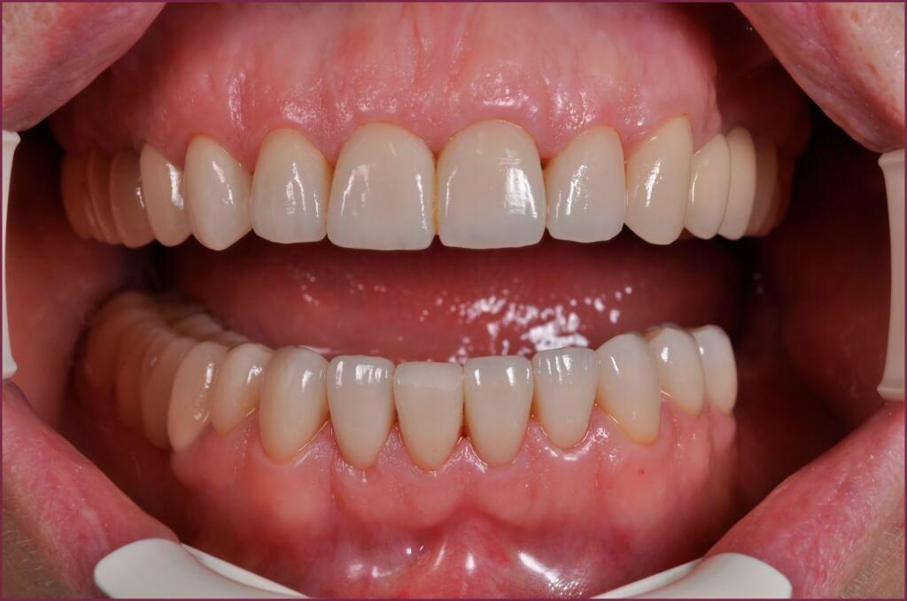 Металлоакрил и зубные протезы - принципы создания 4 - Фрезерный CAD/CAM центр Ортос Новости