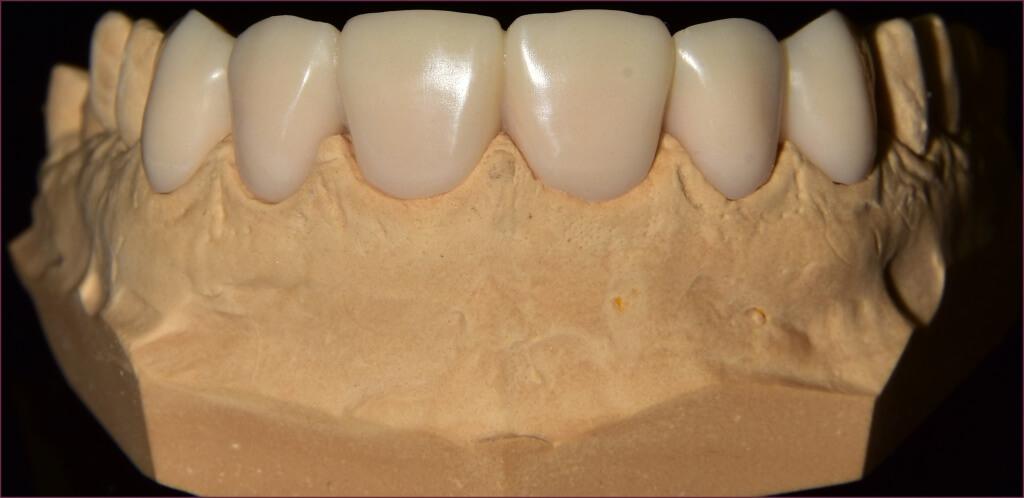 Металлоакрил и зубные протезы - принципы создания 6 - Фрезерный CAD/CAM центр Ортос Новости
