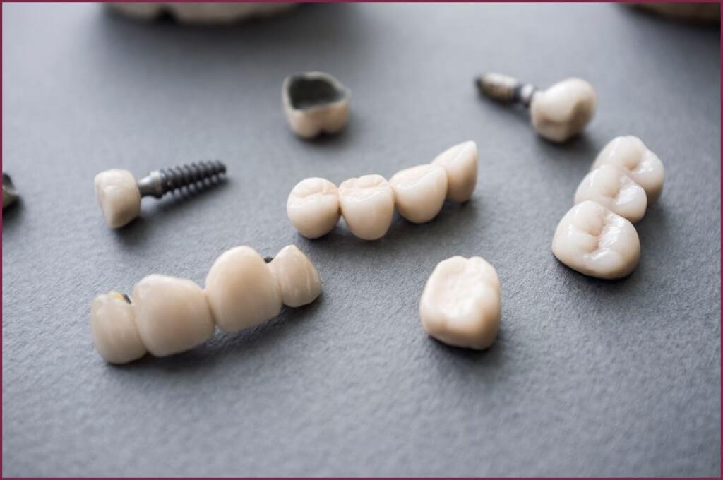 Металлоакрил и зубные протезы - принципы создания 7 - Фрезерный CAD/CAM центр Ортос Новости