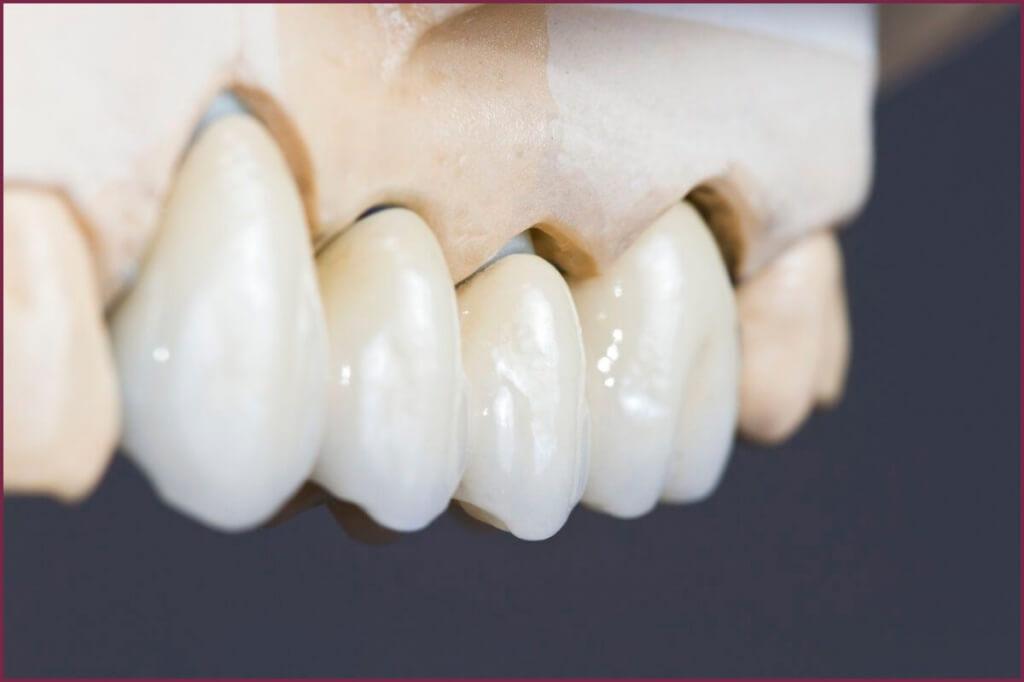 Металлоакрил и зубные протезы - принципы создания 8 - Фрезерный CAD/CAM центр Ортос Новости