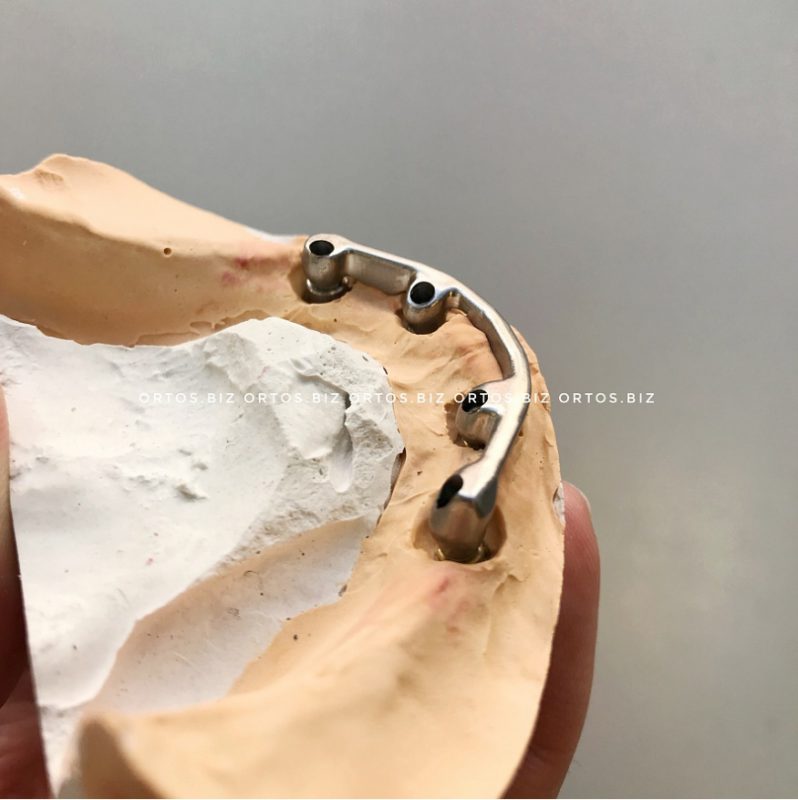 Титановая балка для Implantium на 4 опорах 3 - Фрезерный CAD/CAM центр Ортос Фотографии работ
