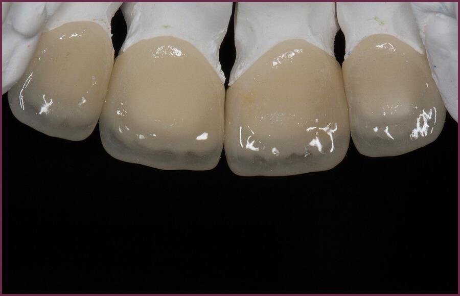 Зубные виниры - особенности материалов 9 - Фрезерный CAD/CAM центр Ортос Новости