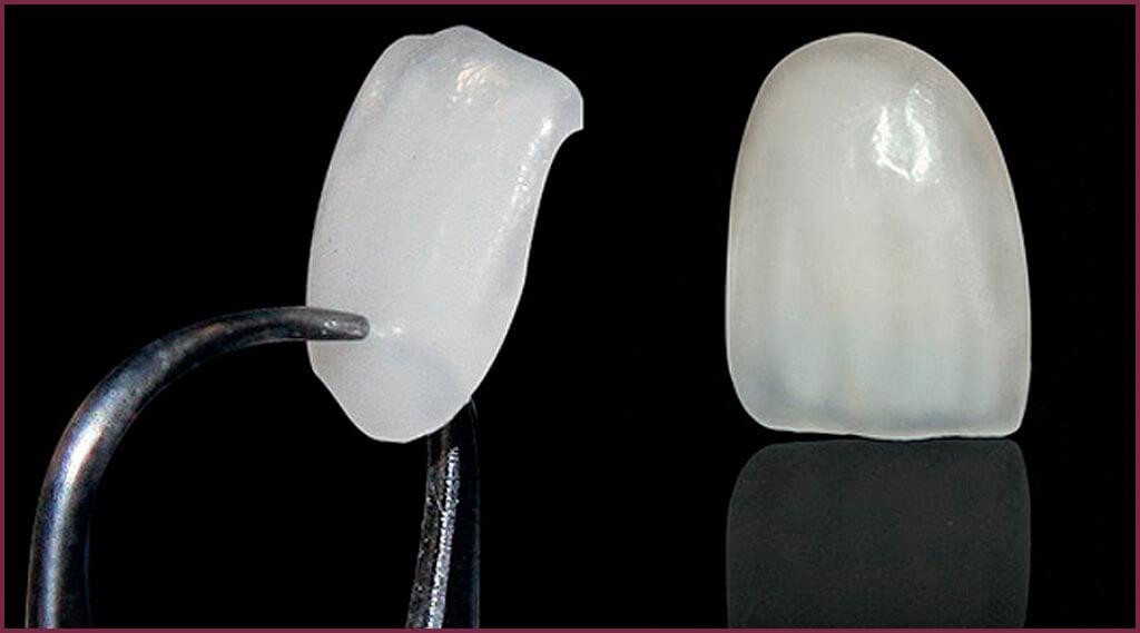 Зубные виниры - особенности материалов 10 - Фрезерный CAD/CAM центр Ортос Новости