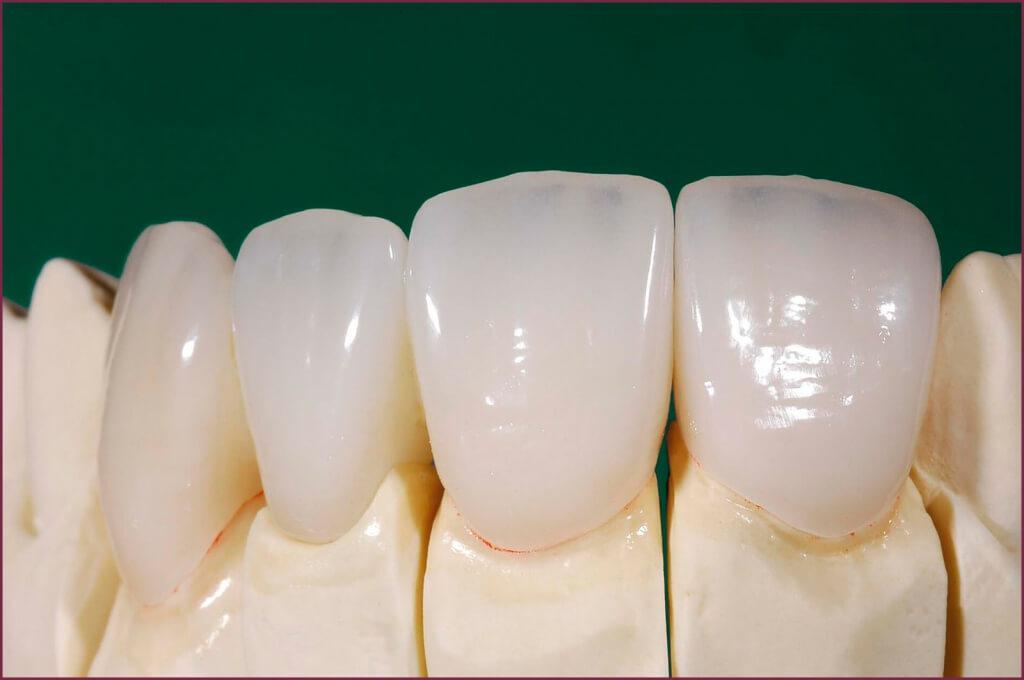 Зубные виниры - особенности материалов 1 - Фрезерный CAD/CAM центр Ортос Новости