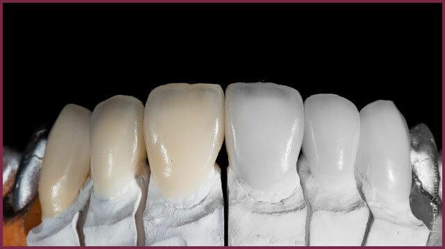 Зубные виниры - особенности материалов 3 - Фрезерный CAD/CAM центр Ортос Новости