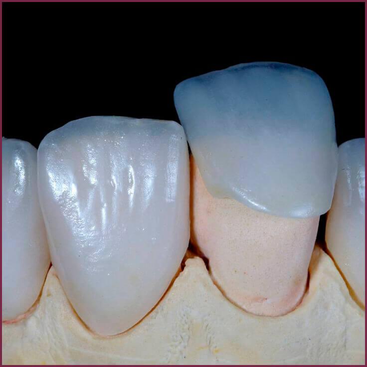 Зубные виниры - особенности материалов 4 - Фрезерный CAD/CAM центр Ортос Новости