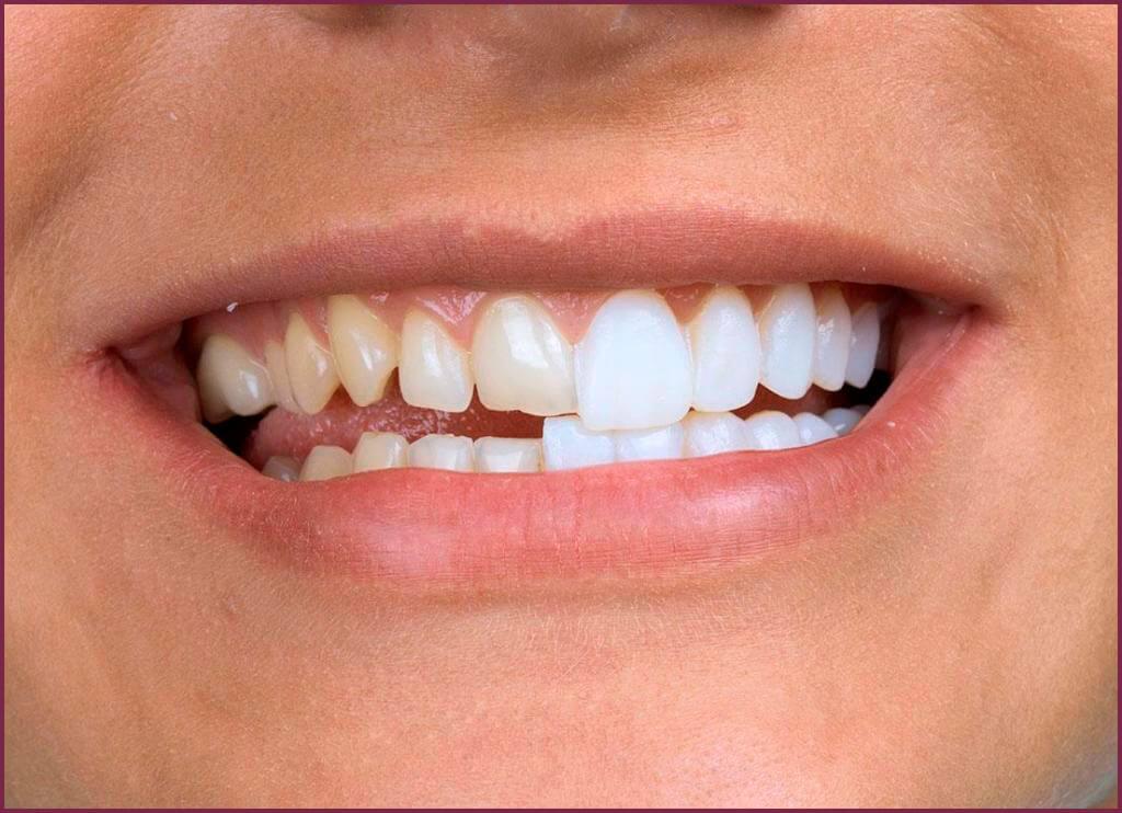 Зубные виниры - особенности материалов 5 - Фрезерный CAD/CAM центр Ортос Новости