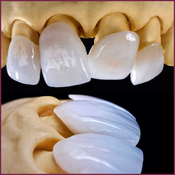 Зубные виниры - особенности материалов 6 - Фрезерный CAD/CAM центр Ортос Новости