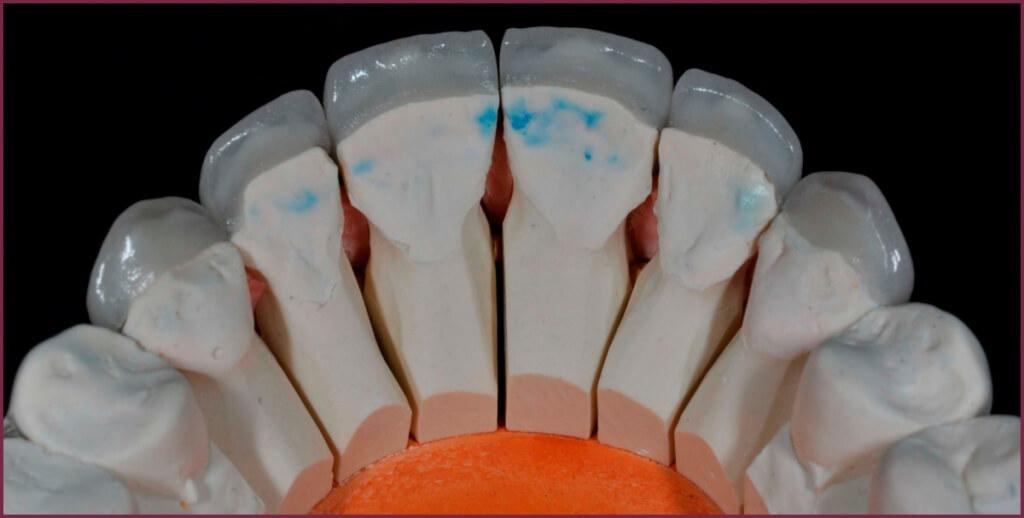 Зубные виниры - особенности материалов 7 - Фрезерный CAD/CAM центр Ортос Новости