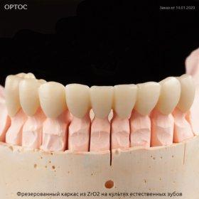 Фрезерованный каркас из ZrO2 А2 на культях естественных зубов 1 - Фрезерный CAD/CAM центр Ортос Новости
