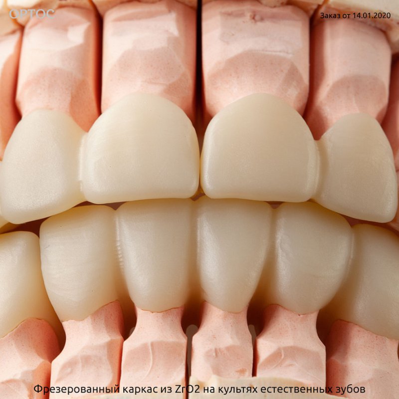 Фрезерованный каркас из ZrO2 А2 на культях естественных зубов 2 - Фрезерный CAD/CAM центр Ортос Новости