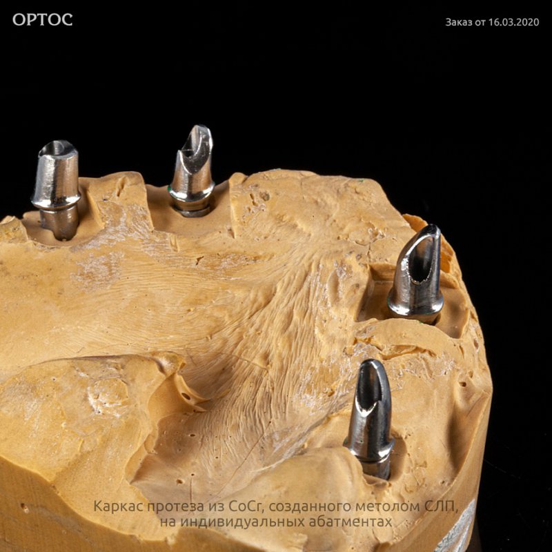 Каркас протеза из CoCr, созданного метолом СЛП, на индивидуальных абатментах 3 - Фрезерный CAD/CAM центр Ортос Новости